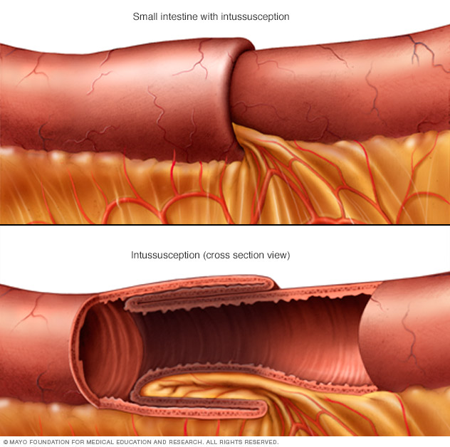 Solitary rectal ulcer syndrome Disease Reference Guide